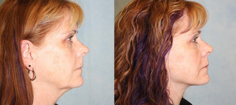 Facelift Patient 8 Image 1