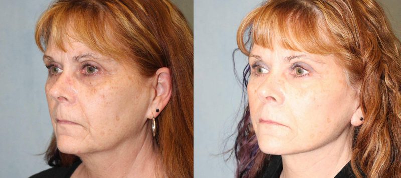 Facelift Patient 8 Image 2