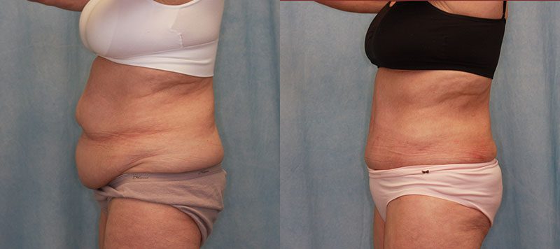 Abdominoplasty Patient 16 Image 2