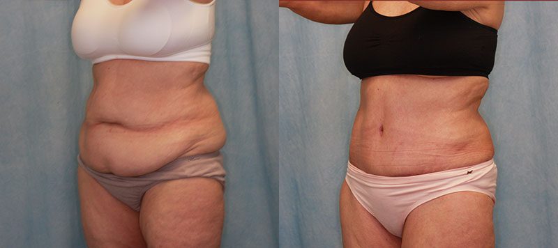 Abdominoplasty Patient 16 Image 1