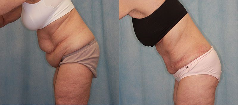 Abdominoplasty Patient 16 Image 0