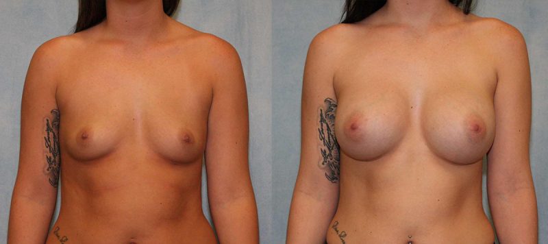 Breast Augmentation Patient 5 Image 3