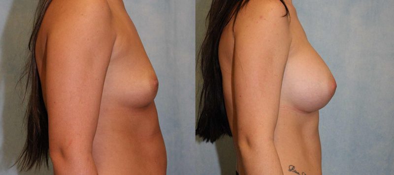 Breast Augmentation Patient 5 Image 2