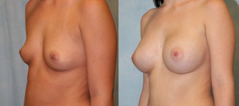Breast Augmentation Patient 5 Image 0