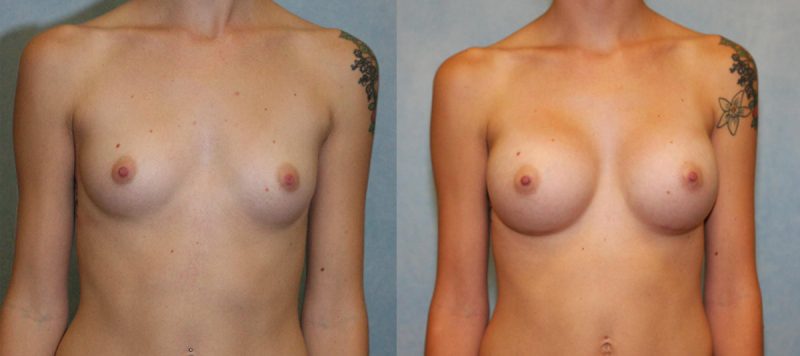 Breast Augmentation Patient 6 Image 4