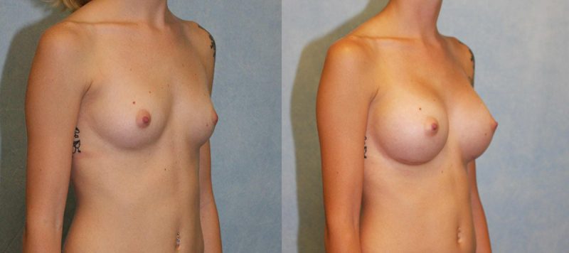 Breast Augmentation Patient 6 Image 2