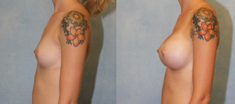 Breast Augmentation Patient 6 Image 1