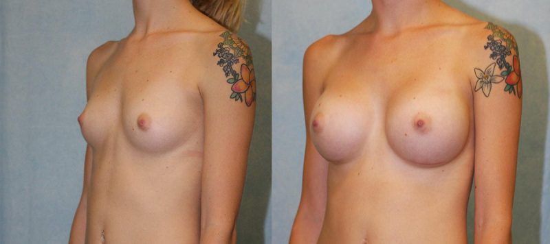 Breast Augmentation Patient 6 Image 0