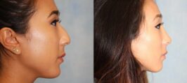 Rhinoplasty Before and After Photo 1