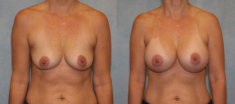 Breast Augmentation Patient 3 Image 3