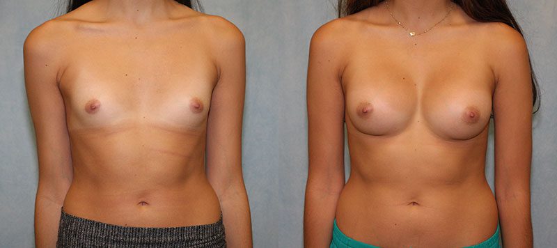 Breast Augmentation Patient 22 Image 2