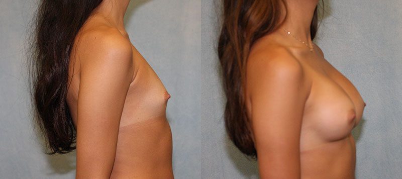 Breast Augmentation Patient 22 Image 3