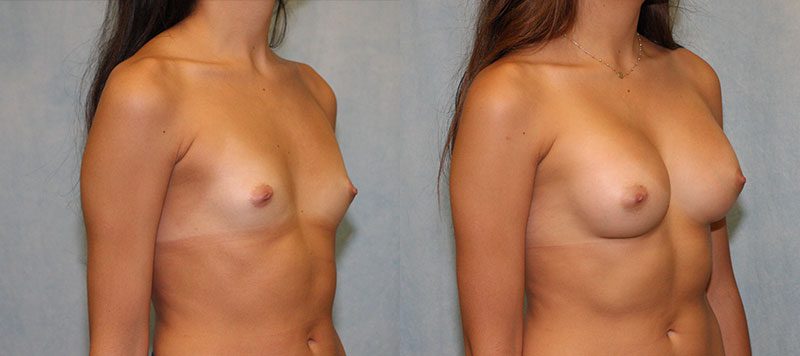 Breast Augmentation Patient 22 Image 1