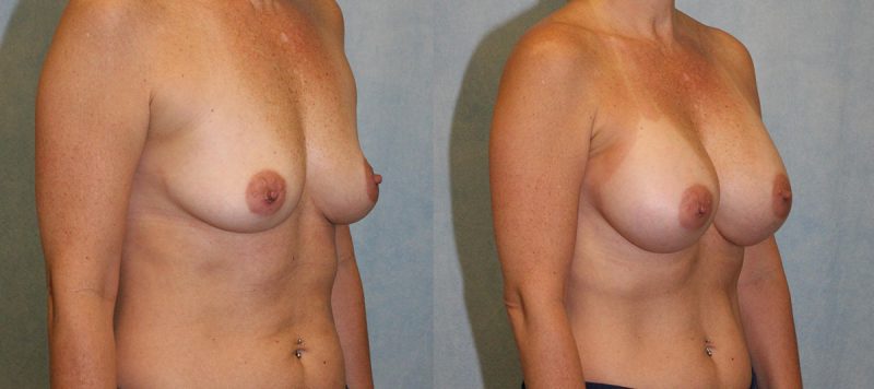 Breast Augmentation Patient 2545 Image 1
