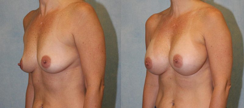 Breast Augmentation Patient 3 Image 0