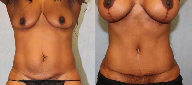 Abdominoplasty Patient 15 Image 0