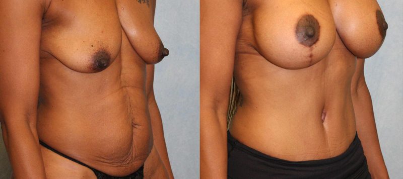 Abdominoplasty Patient 15 Image 1