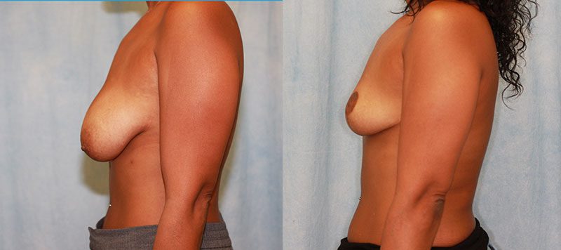 Breast Lift Patient 10 Image 0