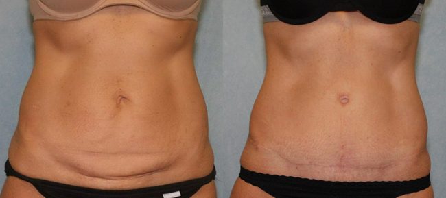 Abdominoplasty Patient 12 Image 2