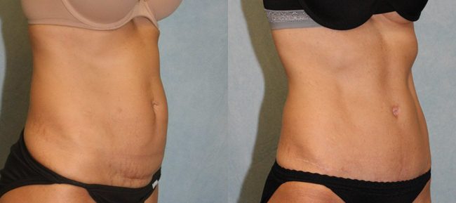 Abdominoplasty Patient 12 Image 1