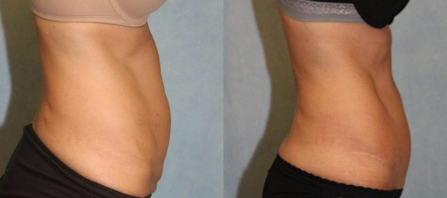 Abdominoplasty Patient 12 Image 0