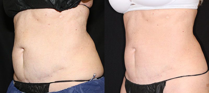 CoolSculpting Patient 4 Image 0