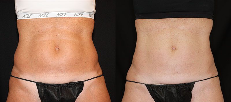 CoolSculpting Patient 7 Image 0