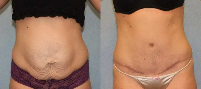 Abdominoplasty Patient 11 Image 4