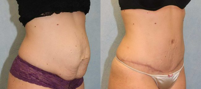 Abdominoplasty Patient 11 Image 3