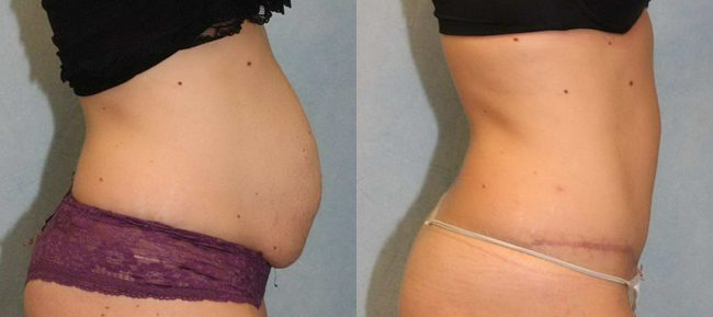 Abdominoplasty Patient 11 Image 2