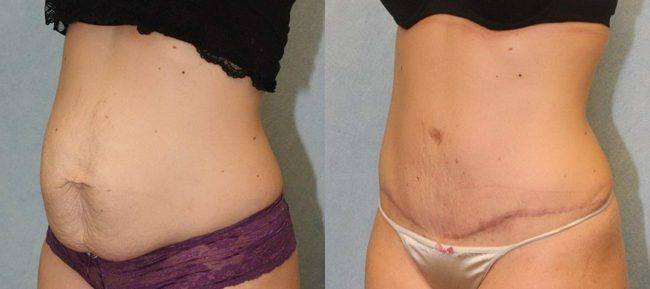 Abdominoplasty Patient 11 Image 1