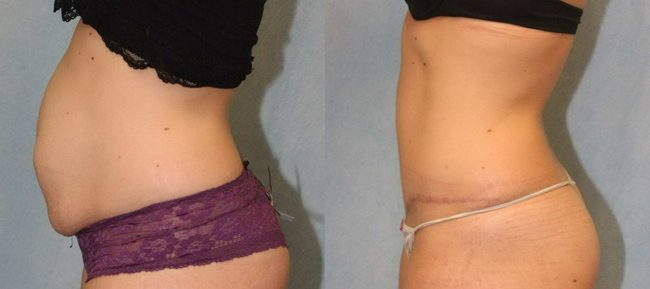 Abdominoplasty Patient 11 Image 0