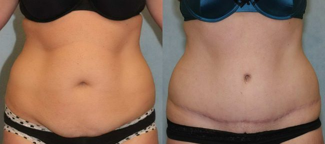 Abdominoplasty Patient 13 Image 5