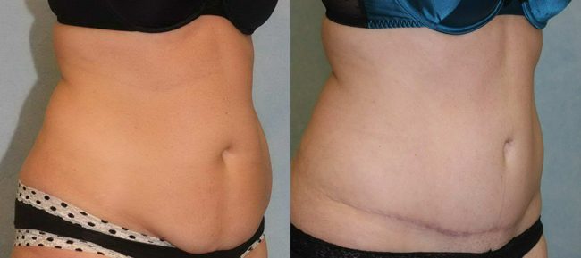 Abdominoplasty Patient 13 Image 4