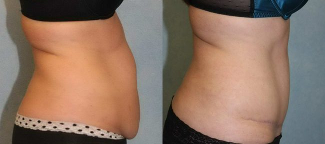 Abdominoplasty Patient 13 Image 3