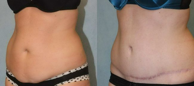 Abdominoplasty Patient 13 Image 2