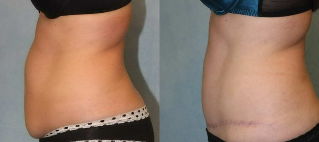 Abdominoplasty Patient 13 Image 1