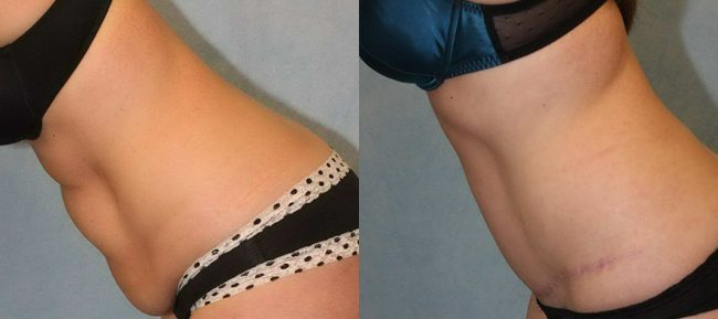 Abdominoplasty Patient 13 Image 0