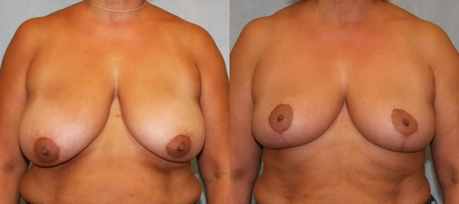 Breast Reduction Patient 2 Image 4
