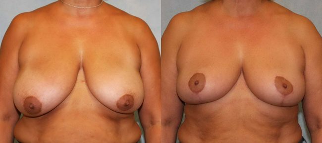 Breast Reduction Patient 2 Image 4