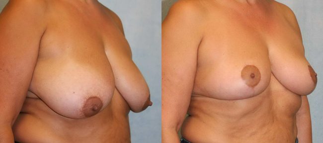 Breast Reduction Patient 2 Image 3