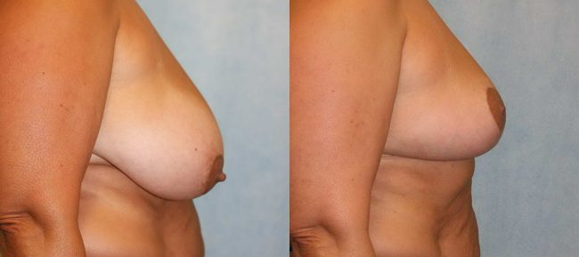 Breast Reduction Patient 2 Image 2