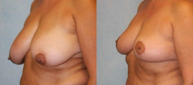 Breast Reduction Patient 2 Image 1