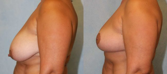 Breast Reduction Patient 2 Image 0
