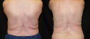 Coolsculpting Before and After Photo 1