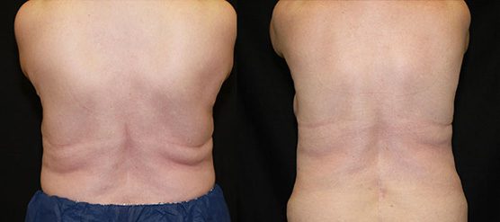 Coolsculpting Before and After Photo 1