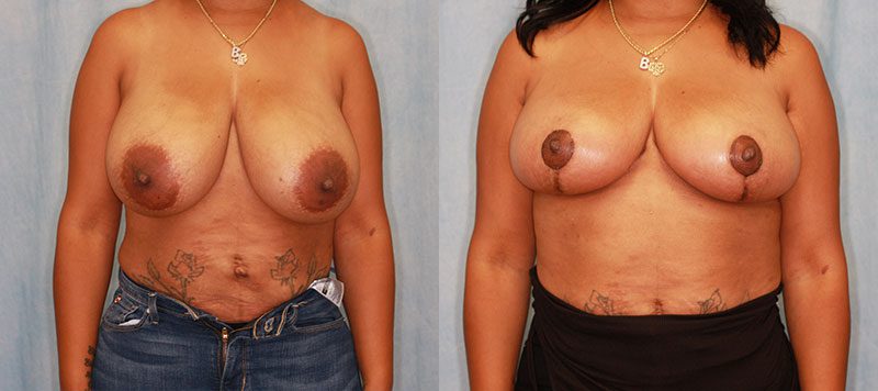 Breast Reduction Patient 8 Image 3