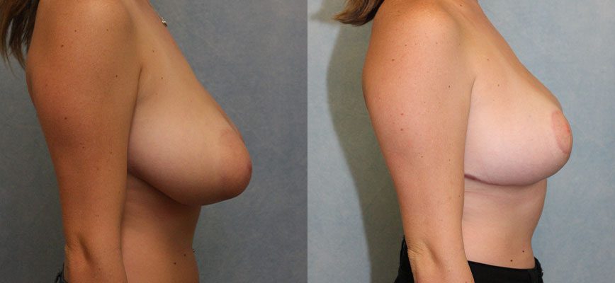 Breast Reduction Patient 2766 Image 1