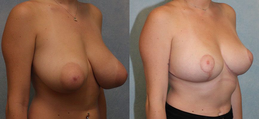 Breast Reduction Patient 9 Image 0