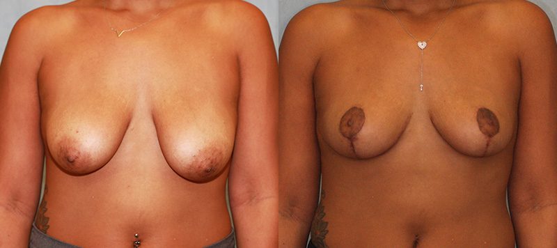 Breast Lift Patient 8 Image 0